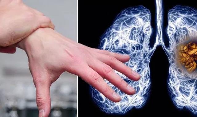 عرض خفي لسرطان الرئة يظهر على اليدين – منبر العراق الحر